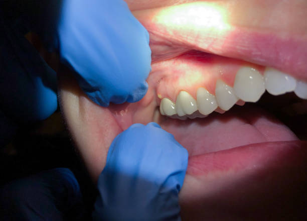Best Knocked-Out Tooth (Avulsed Tooth) Treatment in Hayfork, CA